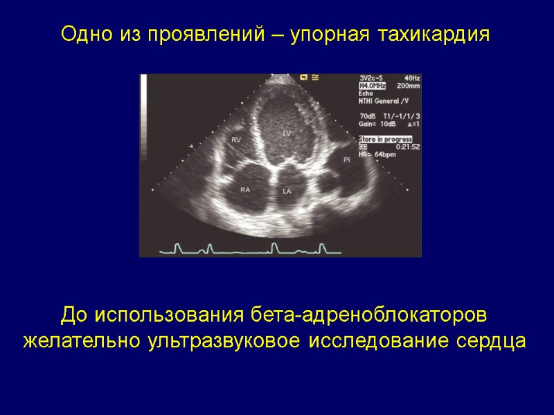 Одно из проявлений – упорная тахикардия До использования бета-адреноблокаторов желательно ультразвуковое исследование сердца